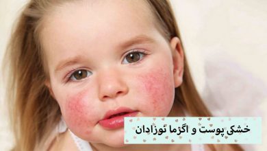 تصویر درمان خشکی پوست و اگزما نوزادان و جلوگیری از آن