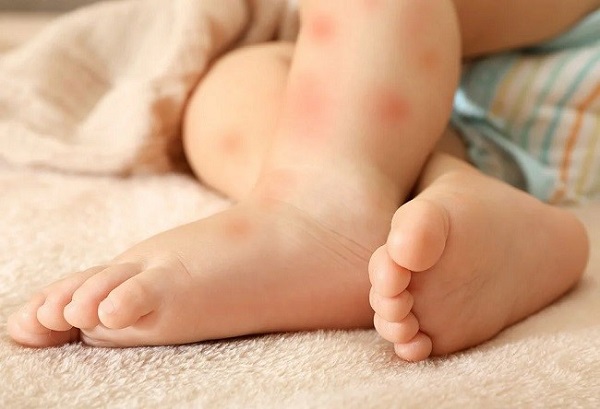 حساسیت به لاکتوز در نوزادان